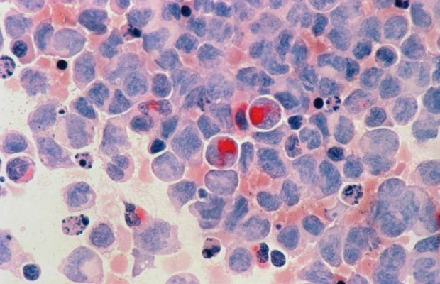Octobre Rose: les métastases commencent enfin à dévoiler leurs secrets